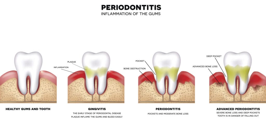 treatment for gum disease in skokie il 