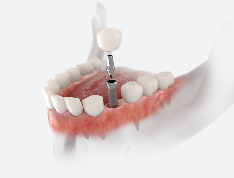Understanding the process for getting a dental implant can help ease anxiety and ensure a quicker recovery.