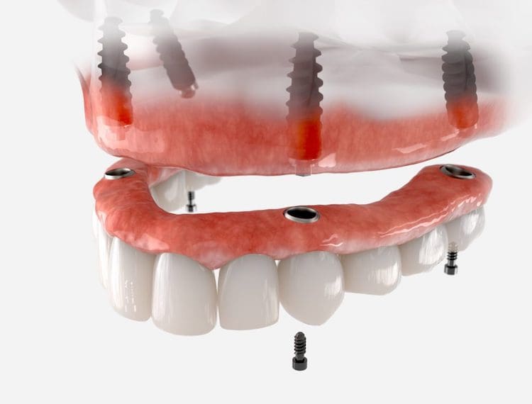Understanding the distinctions between all on four dental implants and dentures is essential for making an informed decision.